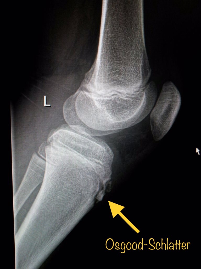 Enfermedad De Osgood Schlatter Sinding Larsen Johansson Y Sever La 