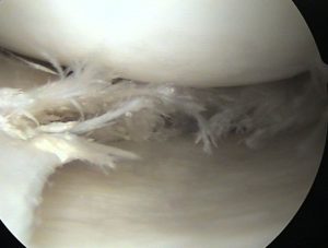 Rotura de menisco en artroscopia de rodilla